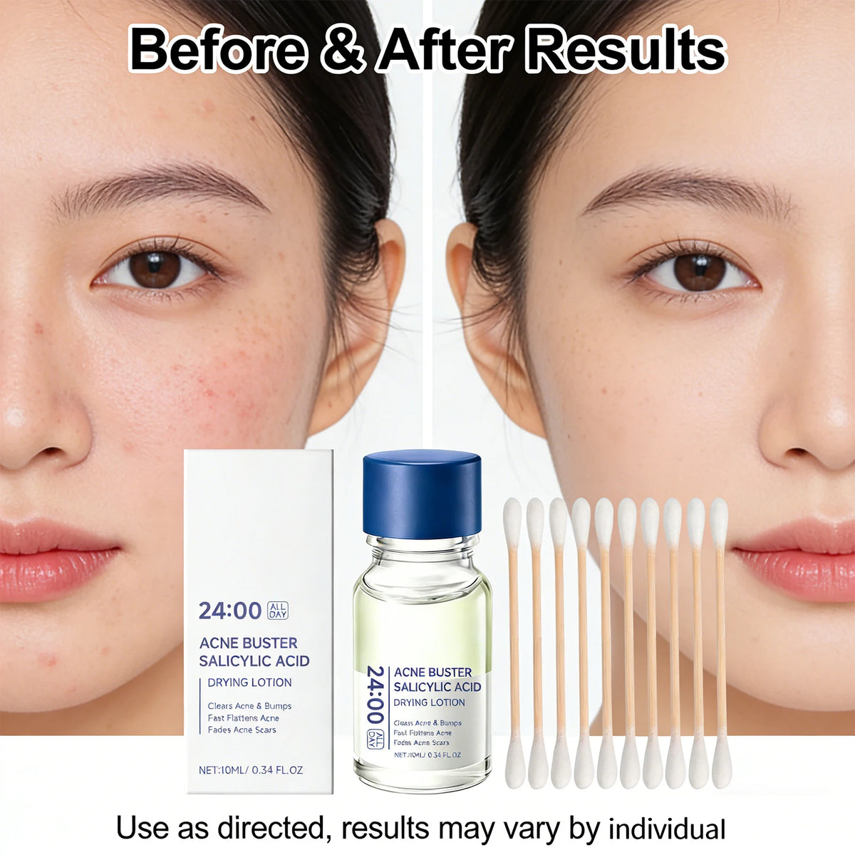 Salicylic Acid Drying Lotion — Acne, Pores & Scar Renewal